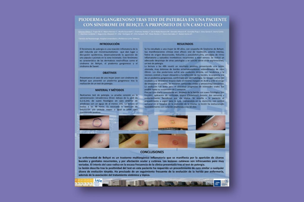 Pioderma gangrenoso tras test de patergia en una paciente con síndrome de Behçet. A propósito de un caso clínico