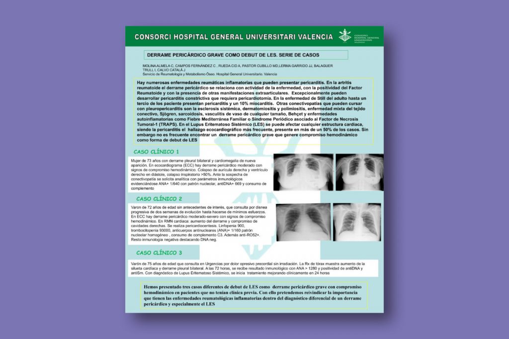 Pleuropericarditis grave como debut de LES. Serie de casos